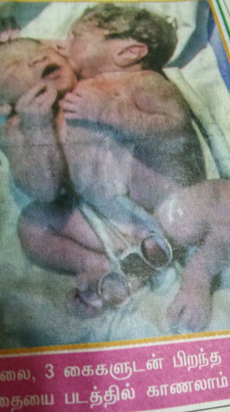 ஒட்டிப் பிறந்த குழந்தைகள்